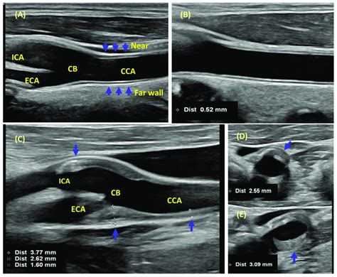 intima-media thickness measurement|cimt test vs carotid ultrasound.